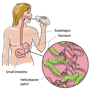 helicobacter pylori