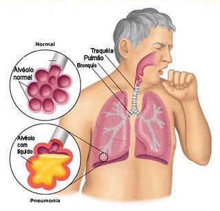 pneumonia_anatomy