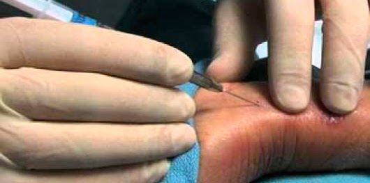 Exame de sangue gasometria arterial